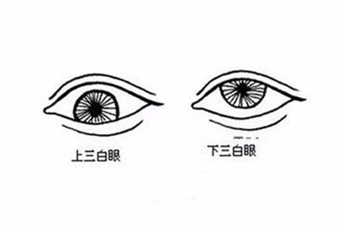 三白眼是什么样 三白眼是是怎么造成的
